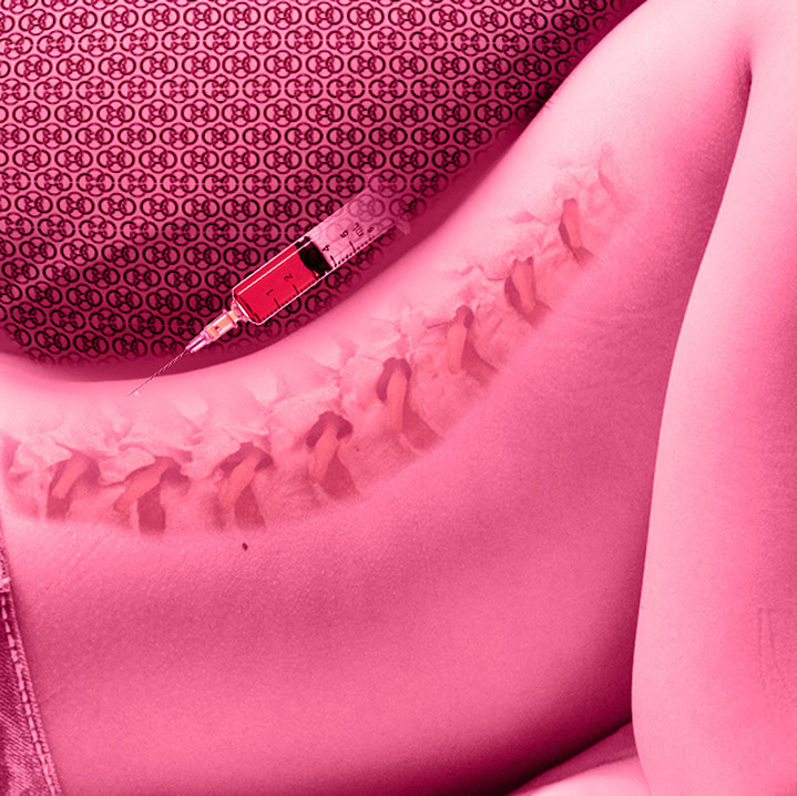 Motiv für die Infiltrationstherapie beim team CO4. Die Ansprechpartner sind Herr Dr. med. Jan-Marcel Hanssen und Herr Dr. med. Lukas Braun.