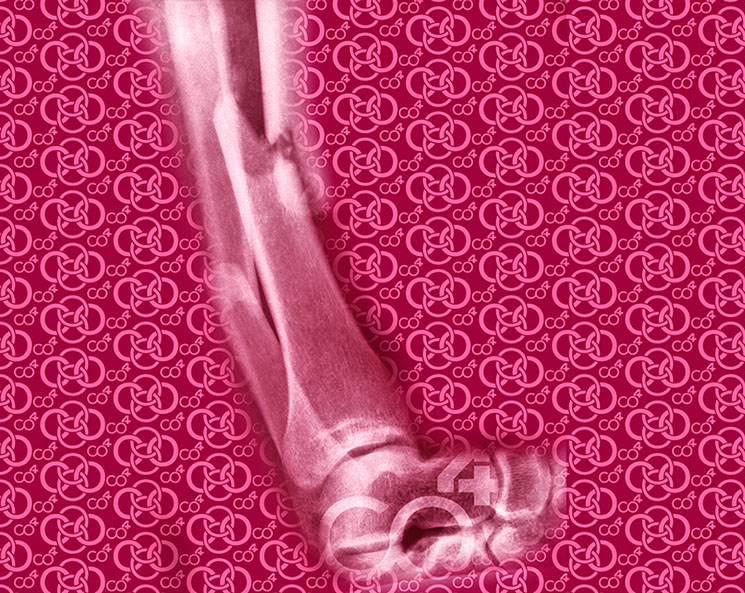 Bild Röntgenaufnahme Knochenbruch mit Praxislogo symbolisiert Fußchirurgie - eines der Fachgebiete der Praxis Berner´s Braun Schneider.