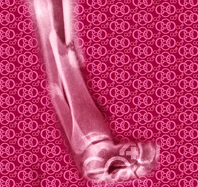 Bild Röntgenaufnahme Knochenbruch mit Praxislogo symbolisiert Fußchirurgie - eines der Fachgebiete der Praxis Berner´s Braun Schneider.