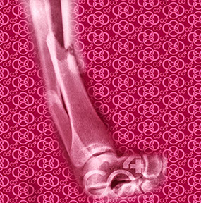 Bild Röntgenaufnahme Knochenbruch mit Praxislogo symbolisiert Fußchirurgie - eines der Fachgebiete der Praxis Berner´s Braun Schneider.