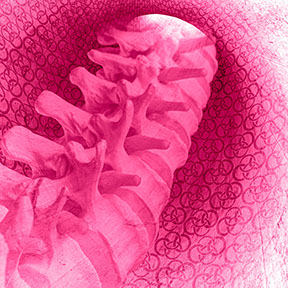 Motiv mikrochirurgische Dekompression bei Spinalkanalstenose. Fachärzte bei CO4: Herr Dr. med. Jan-Marcel Hanssen und Herr Dr. med. Lukas Braun.