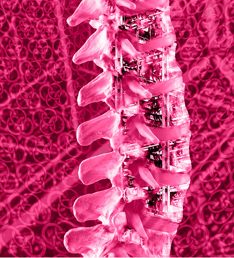 Stabilisierung- bzw. Versteifungsoperation der Wirbelsäule. Ansprechpartner sind Herr Dr. med. Jan-Marcel Hanssen und Herr Dr. med. Lukas Braun.