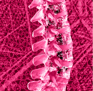 Stabilisierung- bzw. Versteifungsoperation der Wirbelsäule. Ansprechpartner sind Herr Dr. med. Jan-Marcel Hanssen und Herr Dr. med. Lukas Braun.