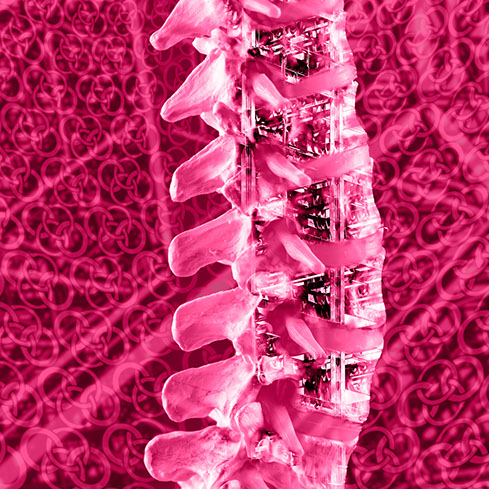 Stabilisierung- bzw. Versteifungsoperation der Wirbelsäule. Ansprechpartner sind Herr Dr. med. Jan-Marcel Hanssen und Herr Dr. med. Lukas Braun.