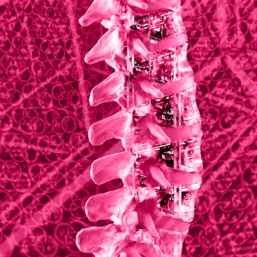 Stabilisierung- bzw. Versteifungsoperation der Wirbelsäule. Ansprechpartner sind Herr Dr. med. Jan-Marcel Hanssen und Herr Dr. med. Lukas Braun.